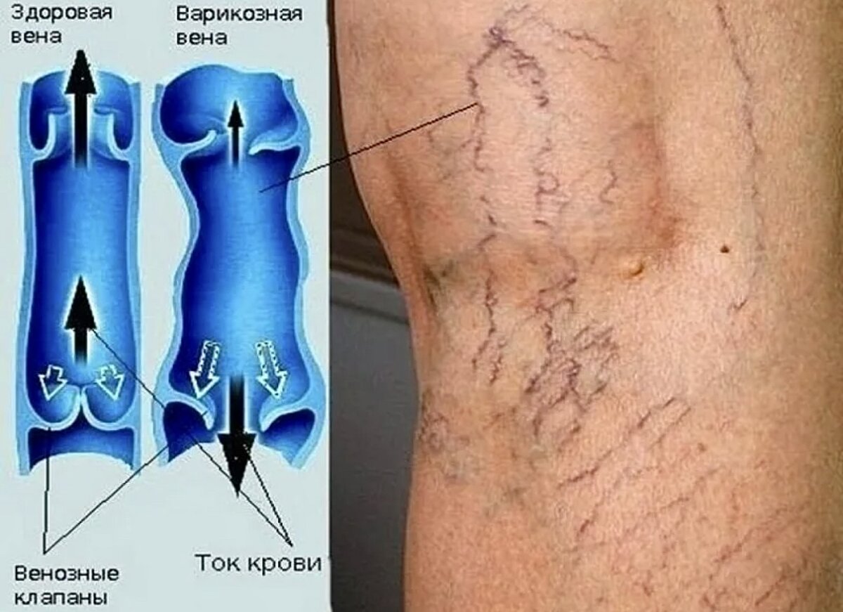 Почему варикоз. Варикозное заболевание вен нижних конечностей. Варикозное расширение вен лимфангит. Варикозно расширенные вены. Варикозно расширенные вены ног.