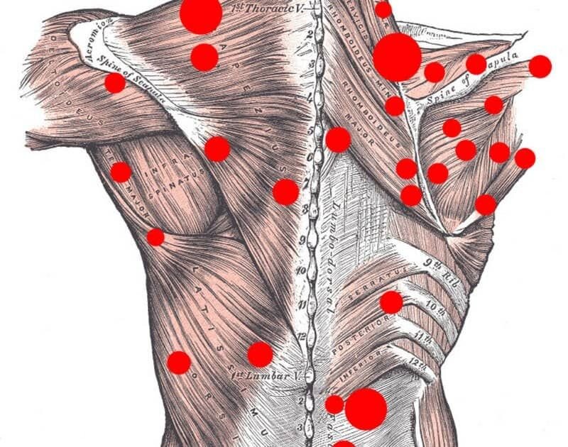 Спина спайка. Триггерные точки в грудной мышце. Миофасциальный синдром триггерные точки. Триггерные точки на спине. Триггерные точки грушевидной мышцы.