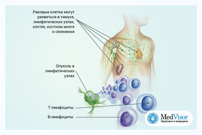 Лимфома Ходжкина или Лимфогранулематоз- Симптомы- Лечение| Данные 