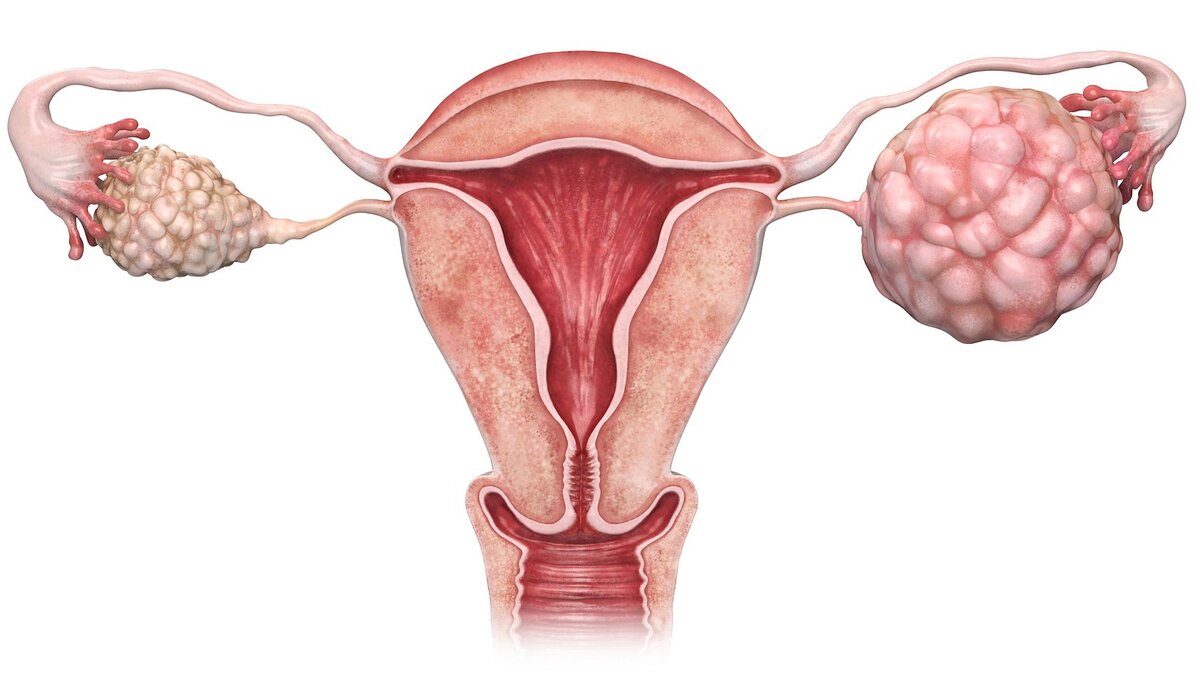 Синдром поликистозных яичников: причины, симптомы и влияние на здоровье |  Гастроцентр Эксперт | Дзен