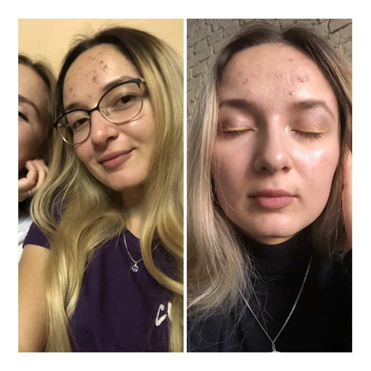 Фотографии моего лица в период обострения угревой болезни 