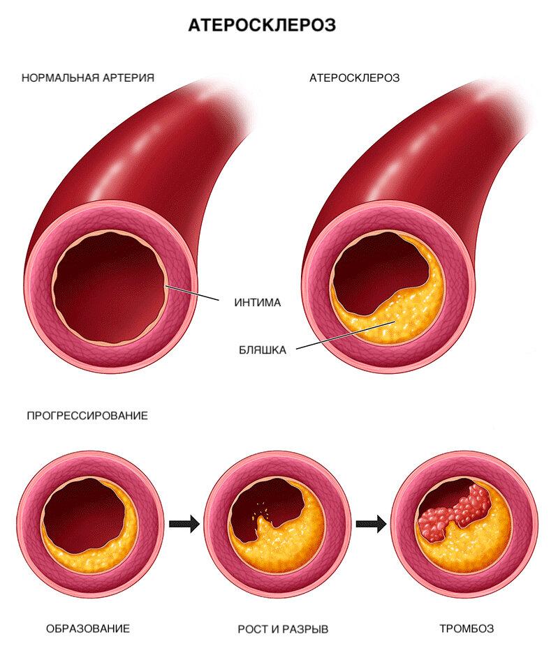 Атеросклероз предполагает постепенное накопление бляшек внутри артерии. В конце концов, бляшка может разорваться и вызвать образование тромба. 