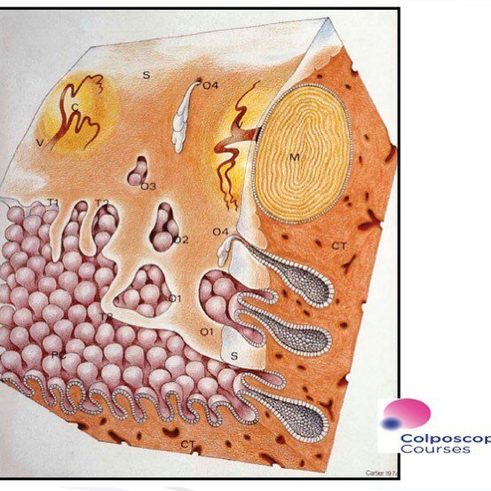 S - многослойный плоский эпителий РС - цилиндрический эпителий
Т1-Т2 - граница эпителиев, внутренний стык, начало зоны трансформации
О1-О2-О3 - островки цилиндрического эпителия
О4 - открытый проток железы
СТ - строма
С - киста, Ovula Nabothii
V - сосуд