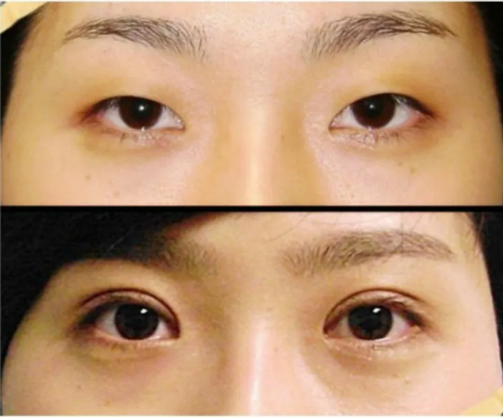 Операция на глаза веко до и после фото