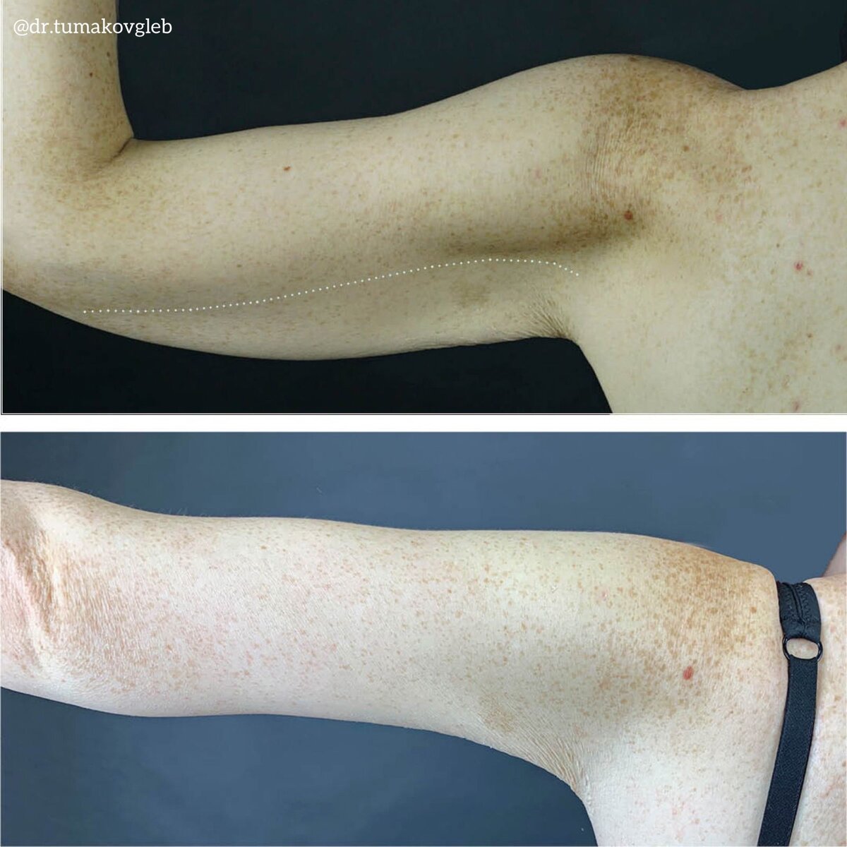 Результат брахиопластики.