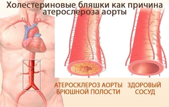 Атеросклероз аорты и артерий