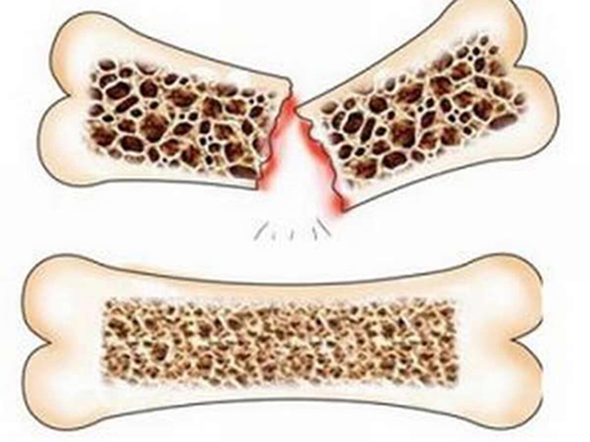 Кости причина. Остеопороз плотность кости. Остеопороз и деминерализация костей. Остеопороз — снижение плотности костной ткани;. Хрупкость и ломкость костей.