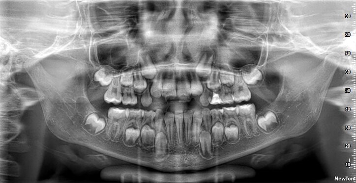 Так выглядит панорамный снимок зубов 7летнего ребёнка 