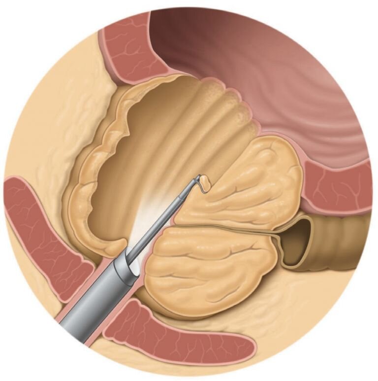Предстательная железа удаление