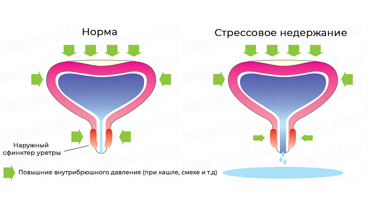 Недержания мочи после родов