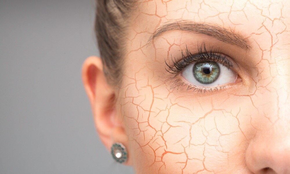 Обратный эффект: почему гиалуроновая кислота может сушить кожу | КРАСОТА &  ЗДОРОВЬЕ | Дзен