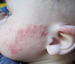 [caption id="attachment_2713" align="alignright" width="320"] Диатез на щеке и ухе[/caption]