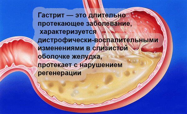 Гастрит признаки. Острый аллергический гастрит. При остром гастрите в слизистой развивается воспаление.