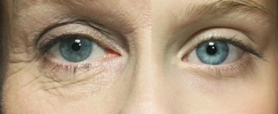  У абсолютного большинства женщин кожа под глазами - очень тонкая и склонна к сухости. Всё вполне объяснимо: в этой области лица практически нет подкожно-жировой клетчатки.