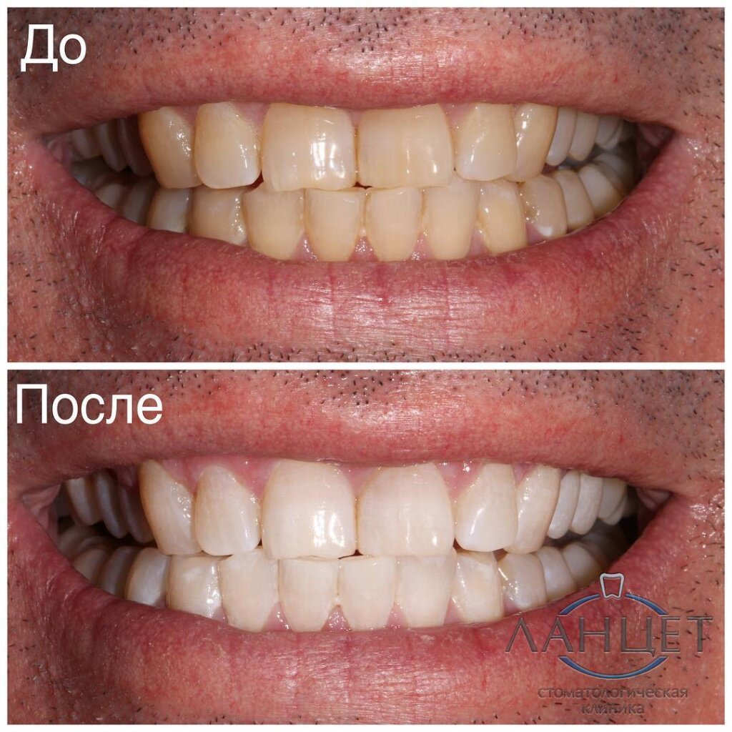 Отбеливание зубов Zoom 4 до и после