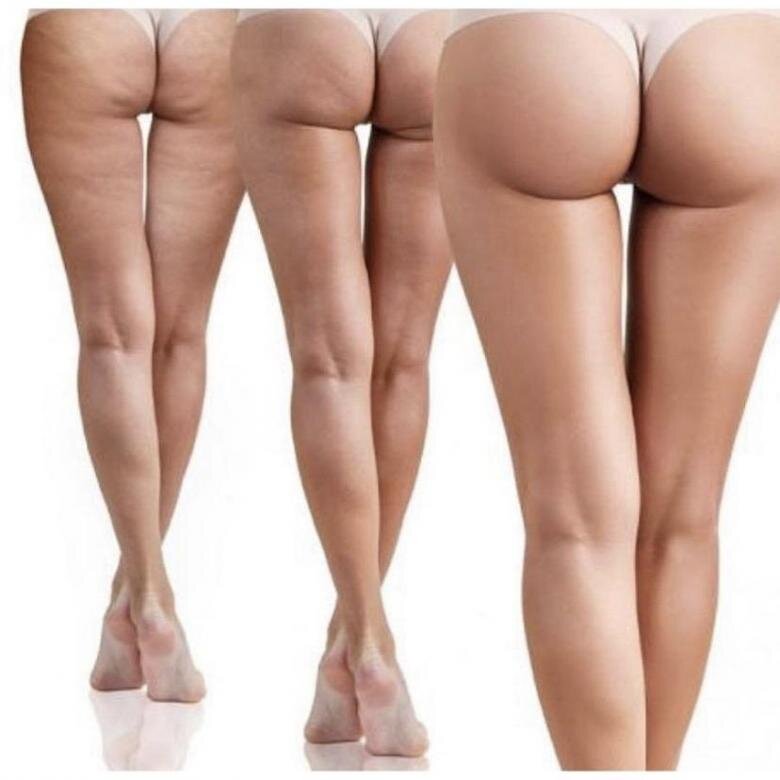 Целлюлит является проблемой многих представительниц прекрасного пола. С ним сталкиваются девушки разного возраста, вне зависимости от веса и телосложения. С точки зрения женской физиологии, целлюлит - абсолютно нормальное явление, однако выглядит это не эстетично, поэтому мы, девушки, зачастую тратим большие деньги на различные косметические средства, услуги диетологов, фитнес-тренеров и массажистов в надежде избавиться от этого недуга.