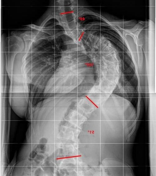 Идиопатический грудной сколиоз 4 степени, до операции