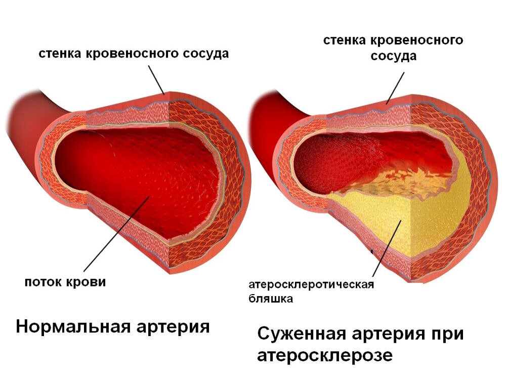 Атеросклероз со. Атеросклеротические бляшки в сосудах.