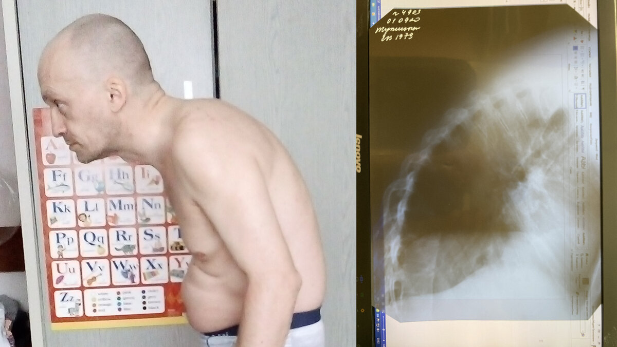 Деформация была довольно сильной — пациент всегда был в согнутом положении, шёл на полусогнутых ногах 