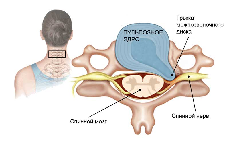Лечение шейной грыжи отзывы. Межпозвоночная грыжа шейного отдела. Межпозвонковая грыжа шейного отдела. Грыжа позвонка шейного отдела. Грыжа межпозвонкового диска в шейном отделе.