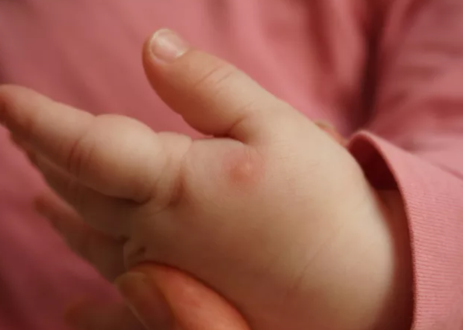 Контактный дерматит у ребенка