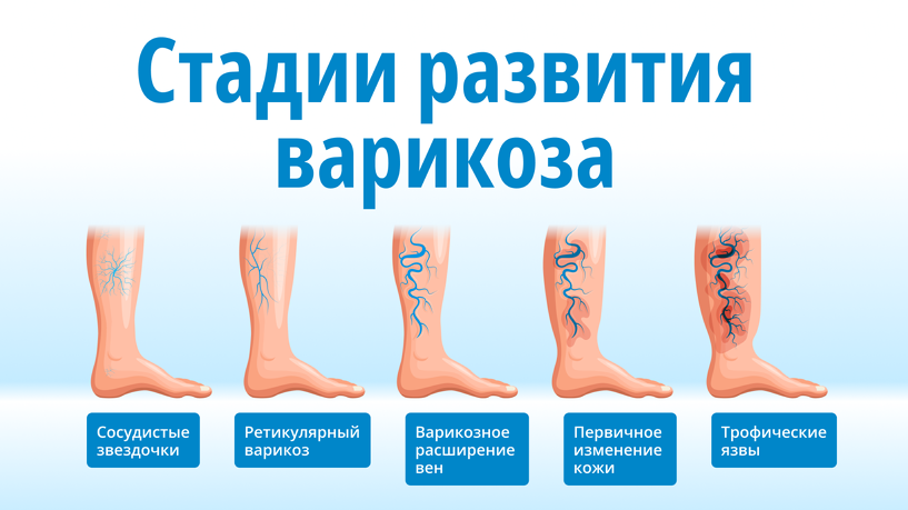 1 стадия варикоза на ногах фото