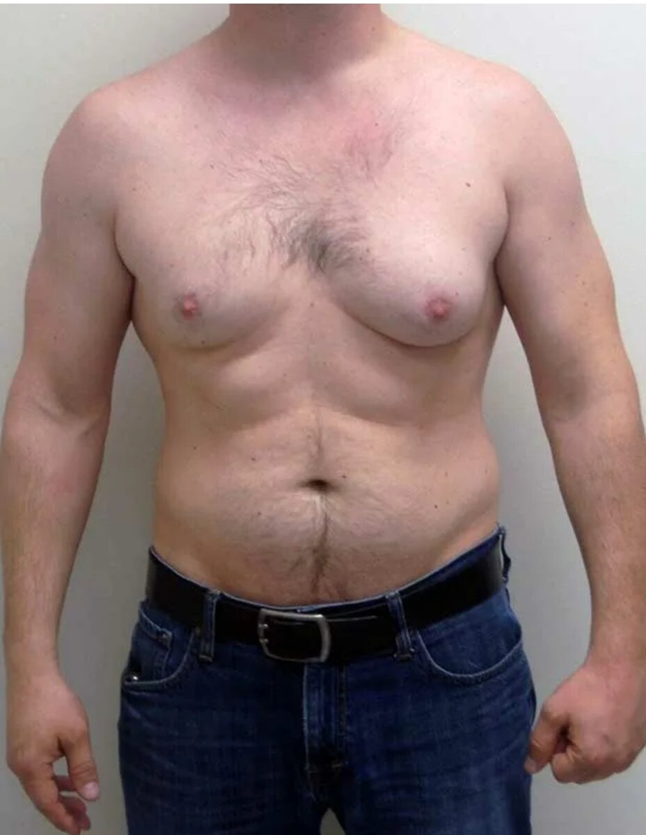 уплотнение в районе груди мужчин фото 18