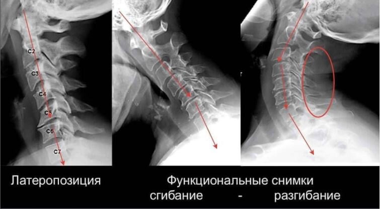 латеропозиция 