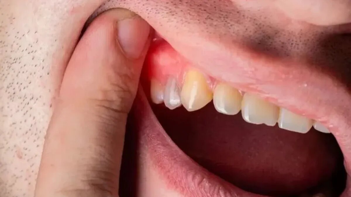 Красные, опухшие десны – показатель пародонтоза (Изображение: Гетти)