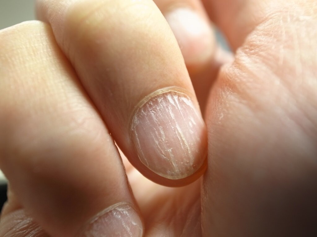 Почему слоятся ногти и как это вылечить