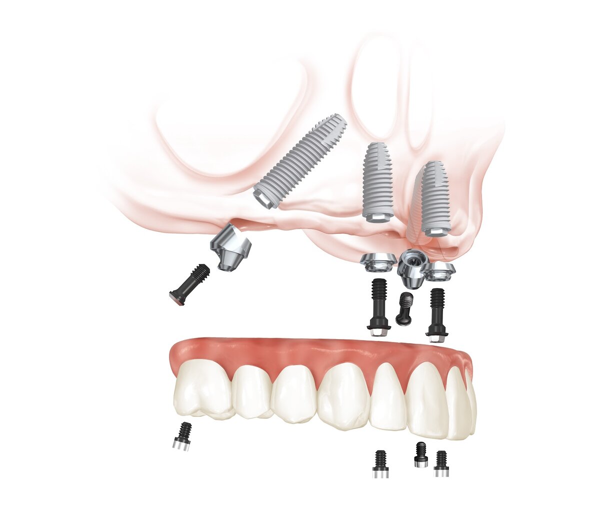 Имплантация челюсти на 4 имплантах