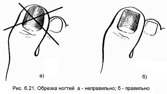  Если не затягивать с решением данной проблемы, то ее можно решить самостоятельно. В первую очередь стоит соблюсти все правила гигиены. Сделайте для ног теплую ванночку, а в воду добавьте немного фурацилина. Если вросший ноготь сделал вам ранку, то тщательно залейте ее перекисью водорода. После этого воспользуйтесь Левомеколом или же Синтомициновой мазью, которой необходимо смазать то место, где возникло заражение. Эти препараты относятся к группе антибиотиков, а поэтому лечение ими должно быть максимально коротким, чтобы не навредить полностью всему организму.  
  
 
