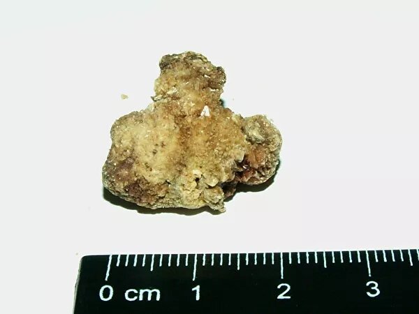 © Фото : Алина Изатулина Оксалатный почечный камень из коллекции Алины Изатулиной. Всего в ее коллекции около двух тысяч камней. Почти 75 процентов из них оксалатные. 