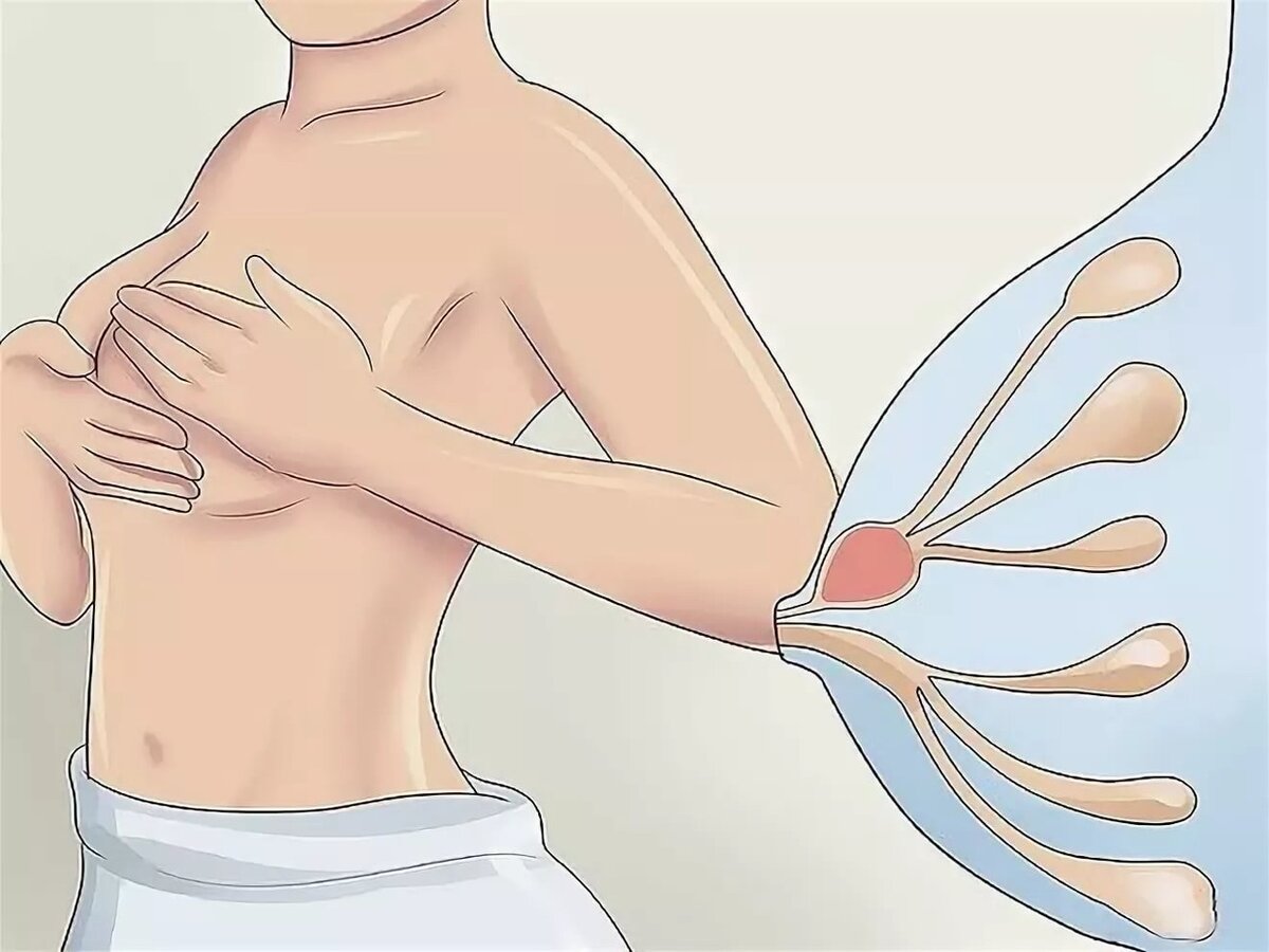 Лактостаз в первый месяц после родов | Мама Таня | Дзен