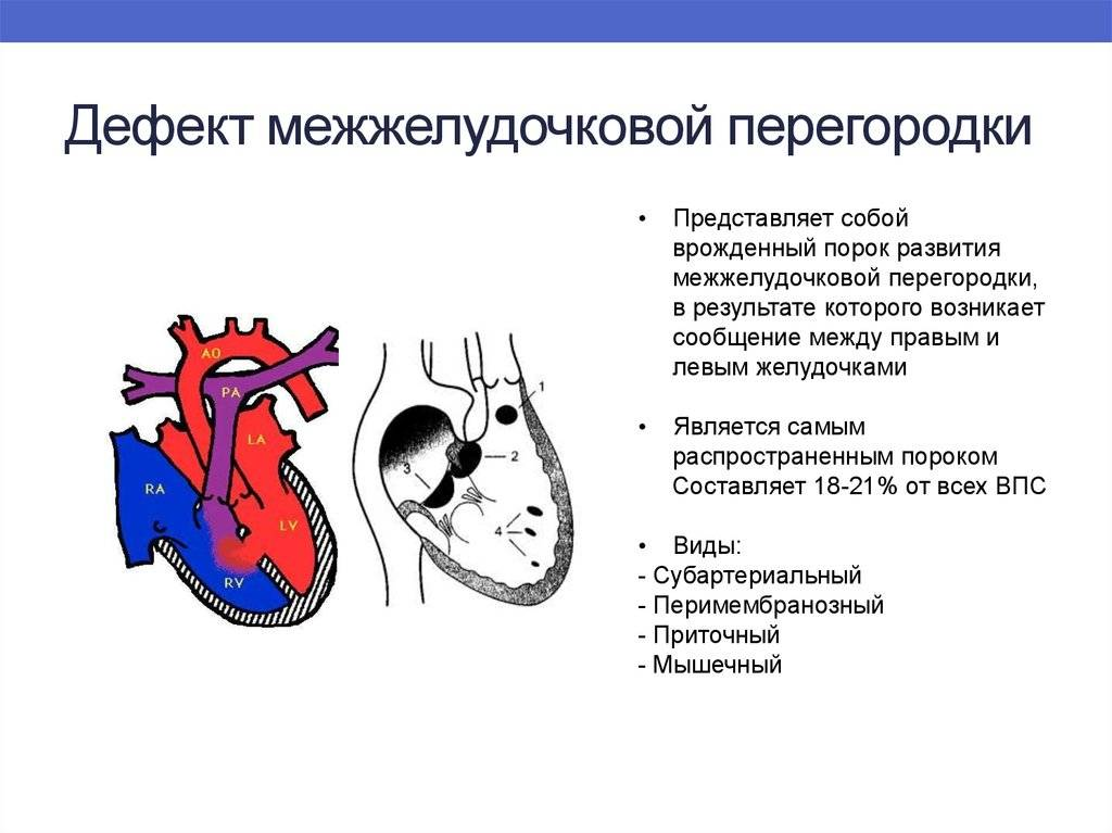 Порок сердца: симптомы, диагностика и лечение