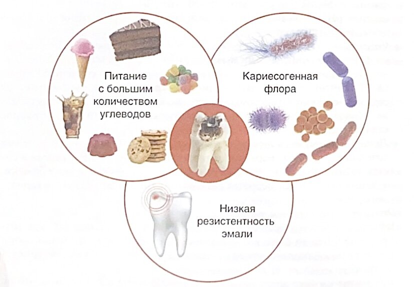 Развитие кариеса зубов (трилистник Кейза с фактором времени)