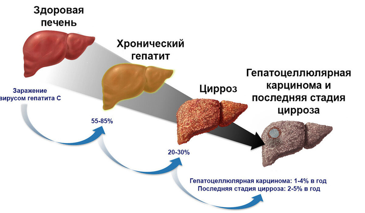 стул при циррозе печени