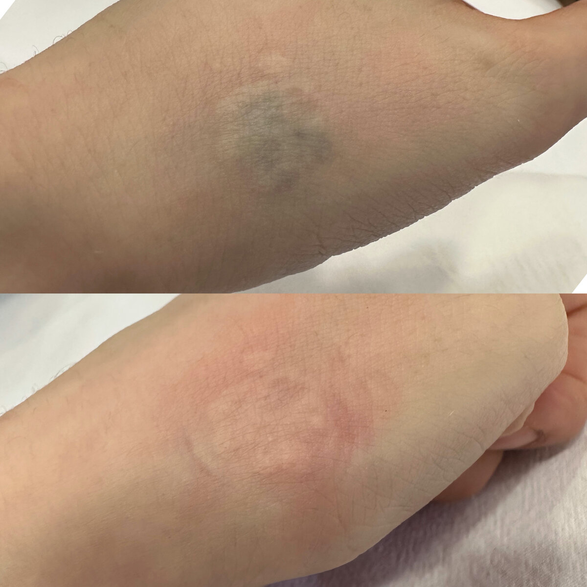 удаление тату за 1 сеанс. 5вспышек effi-clinic.ru