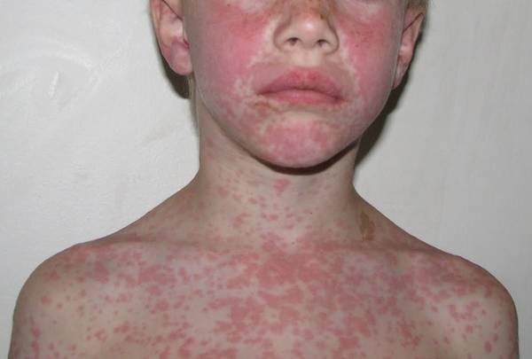Аллергия на антибиотики