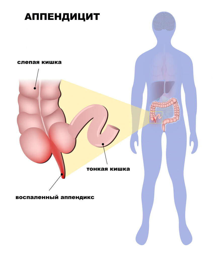 Как вовремя распознать аппендицит? Симптомы и диагностика | Кубань 24.  Полезное | Дзен