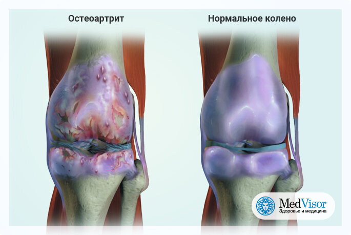 Поражение ног при сахарном диабете 2 типа