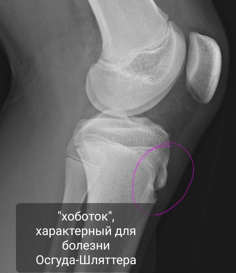 Мкб болезнь осгуда шлаттера