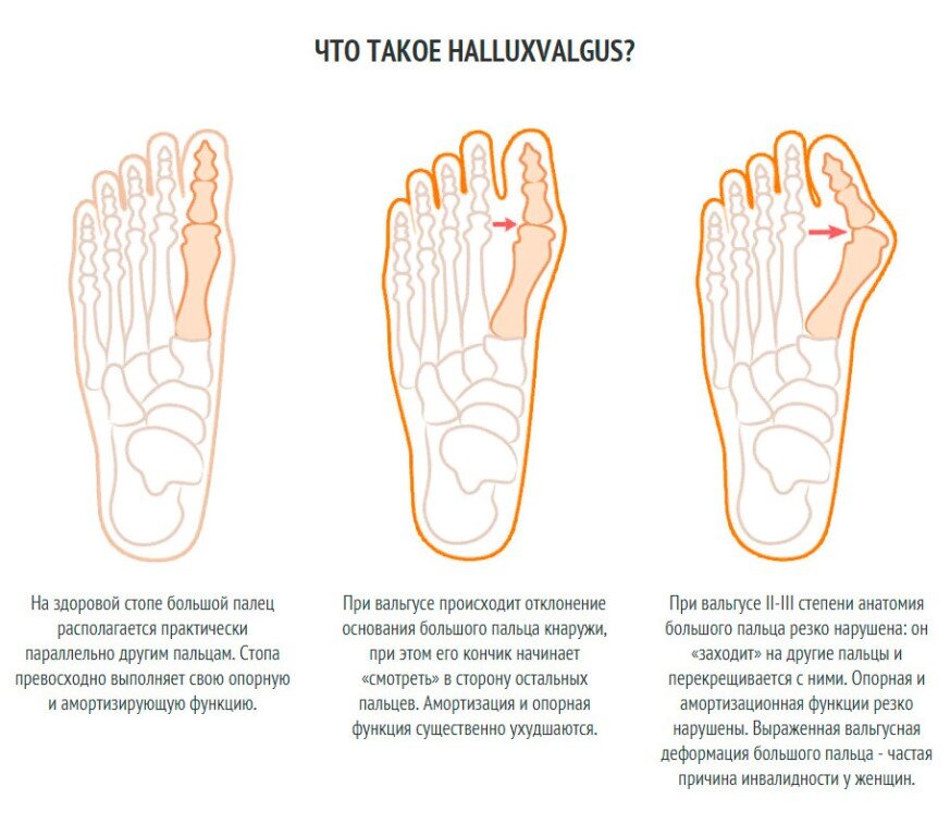 Вальгусная стопа у взрослых операция. Вальгусная деформация стопы упражнения для коррекции. Лечебная физкультура при халюс вальгус. Вальгусная деформация большого пальца плоскостопия.