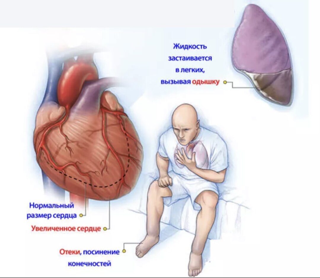 Заболевание сердца сопровождающееся сердечной недостаточностью. Сердечнаяснедостаточность. Сердечная недостаточность. Сесердечная недостаточность это. Сердечна янедостатояность.