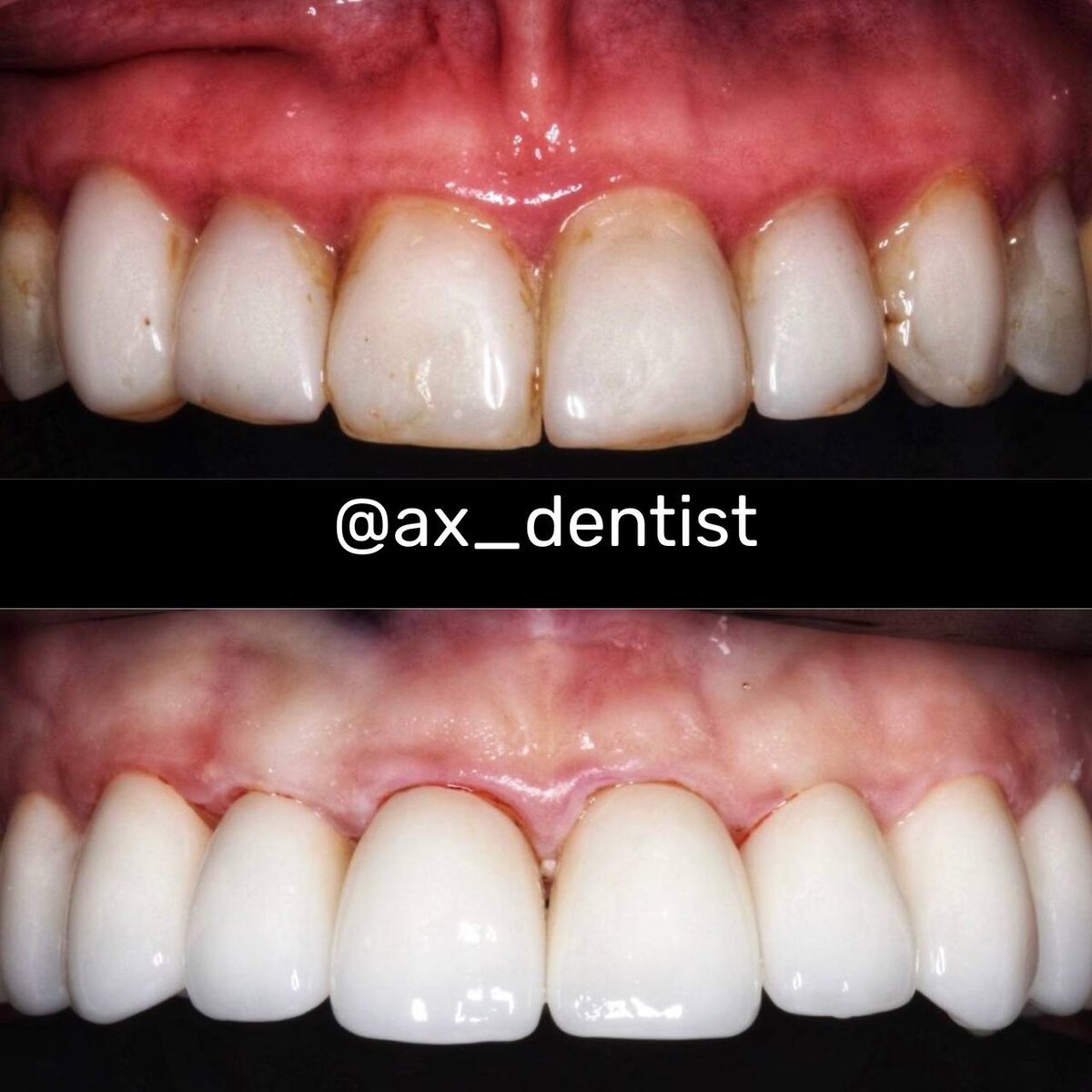 Вверху пример как портятся виниры из композита. Внизу после замены на керамические виниры. 