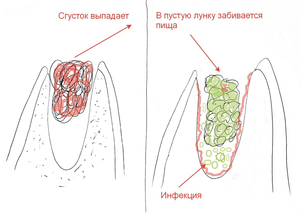 Как выглядит лунка зуба заживает Сага о стоматологии. Глава 24. Что делать если сильно болит после удаления зуба?