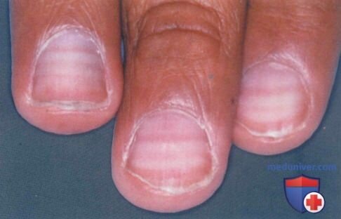 Фото с сайта https://meduniver.com/Medical/Dermat/piatna_i_polosi_na_nogtiax.html