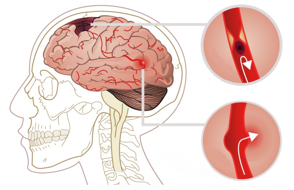 Ischemic stroke. Каскад ишемического инсульта. Геморрагический инсульт. Инсульт картинки. Ишемический и геморрагический инсульт.