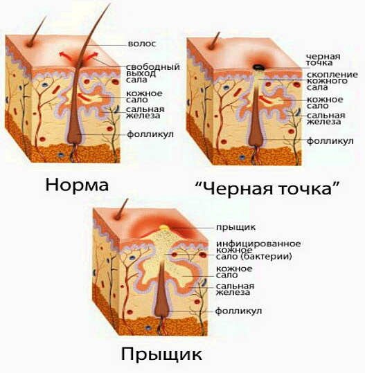 ЧЕРНЫЕ ТОЧКИ/САЛЬНЫЕ НИТИ | OaziS корейская косметика | Дзен