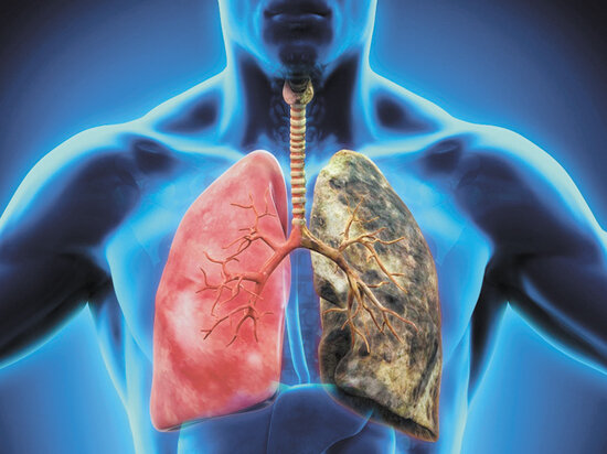 Рак лёгких 